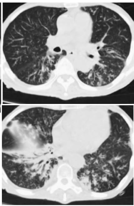 肺部ct基础读片——认识树芽征