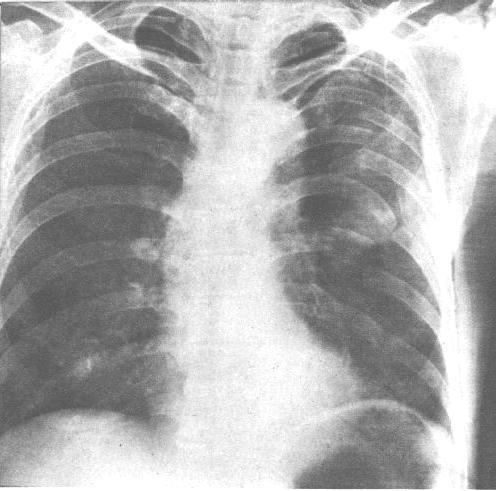 肋骨骨折概述及诊断