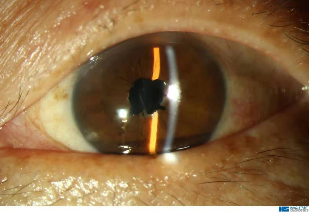 虹膜炎易复发,瞳孔粘连,听到这些她不敢手术了 | 赵小刀手术日志