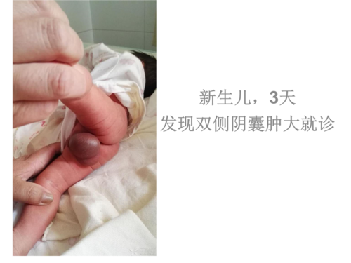 鞘膜外型睾丸扭转选编.ppt