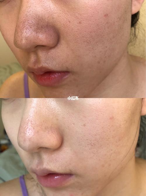 定期去黑头|这前后对比也太明显了吧93_黑头_去黑头