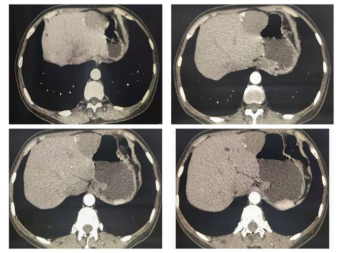 肝血管瘤ct实例分享