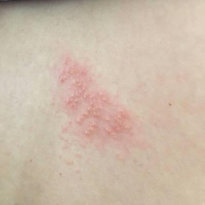 昨天检查医生说是带状疱疹,叫吃药治疗,但是我的宝宝才两个多月,全