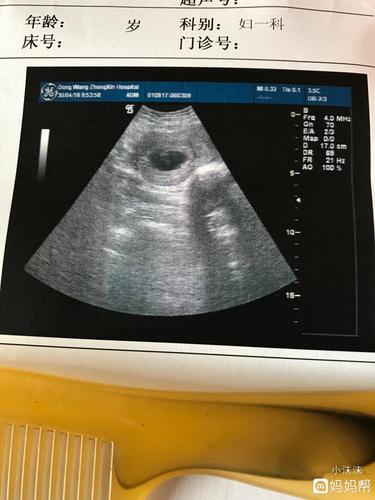 怀孕7周,宫内见一椭圆形孕囊,是男或女,内行姐妹请指教