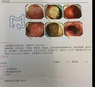 大肠癌早期诊断比例不足10白白错过了这5年黄金期