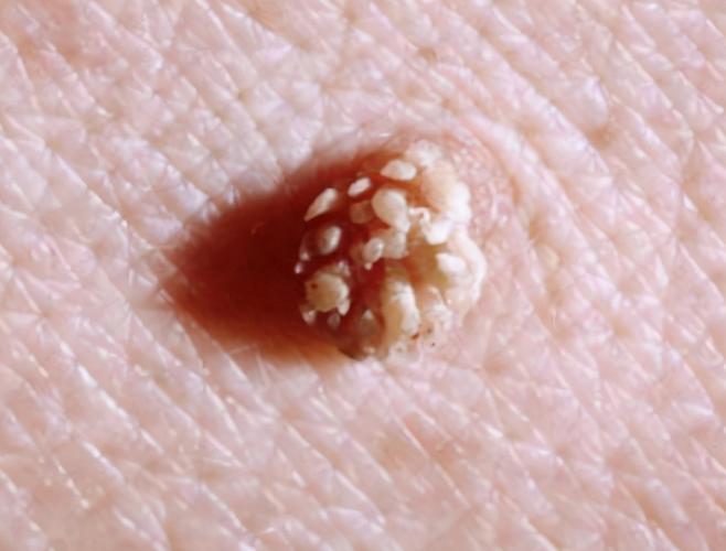 并且,如果hpv病毒不能得到及时清除的话,女性皮肤表面的红疣数量会