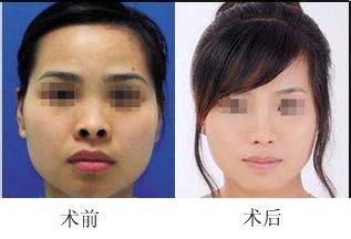 朝天鼻矫正成功案例