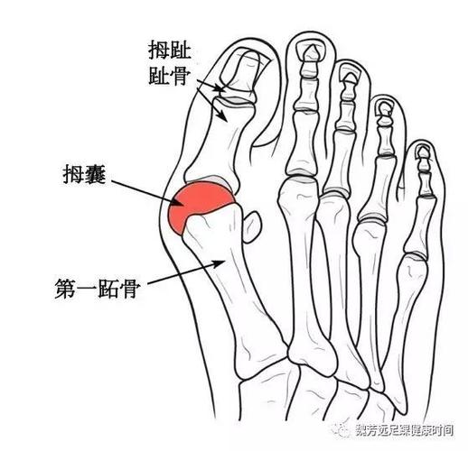 预防及矫正拇外翻,俗称"大脚骨"