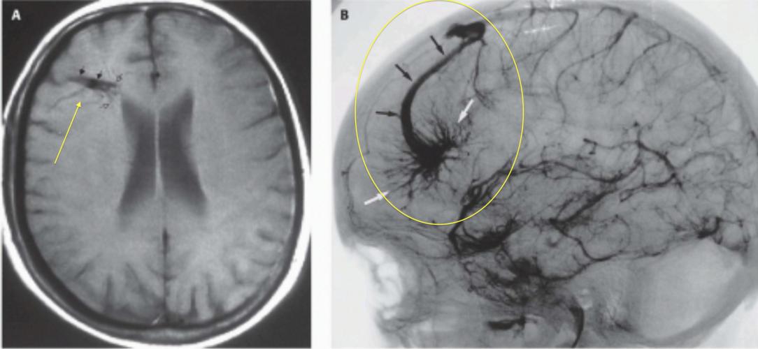 发育性静脉异常_颅内动静脉畸形 - 好大夫在线
