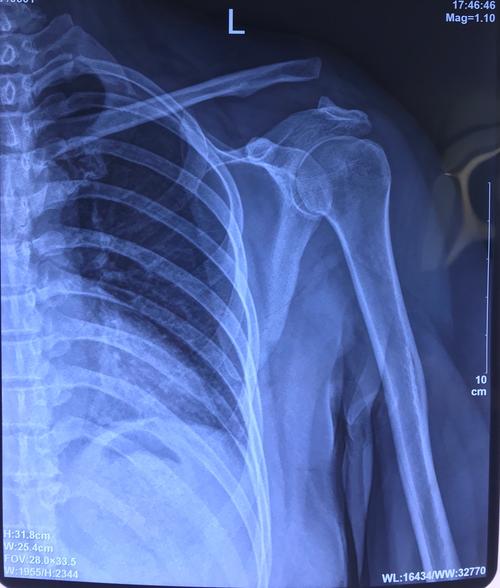 肩锁关节脱位关节镜微创复位固定