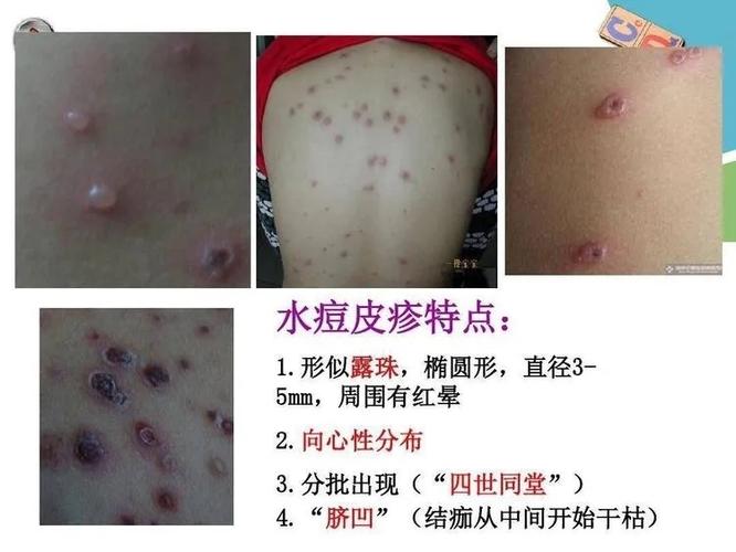 点头童乐第二幼儿园秋冬季传染病——水痘预防知识