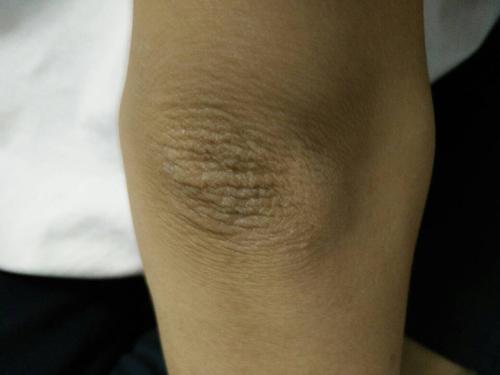 胳膊肘上面的那块死皮怎么弄下去,,我的根本洗不干净 很黑 .