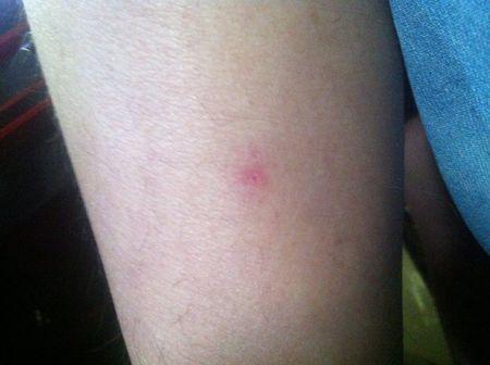 第一,咬伤,被狗咬一般都会看到一条长口子或是两个牙齿印的