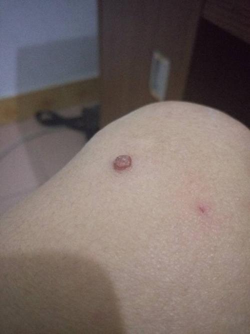 万能的度娘,请问我腿上长的是鸡眼还是鱼鳞痣啊?