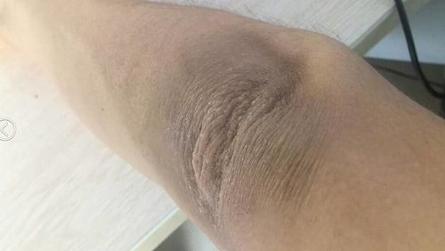 胳膊肘和屁股发黑怎么办?一招教你