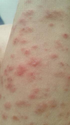 医院第一次诊断是湿疹医院第二次诊断是玫瑰糠疹吃药.