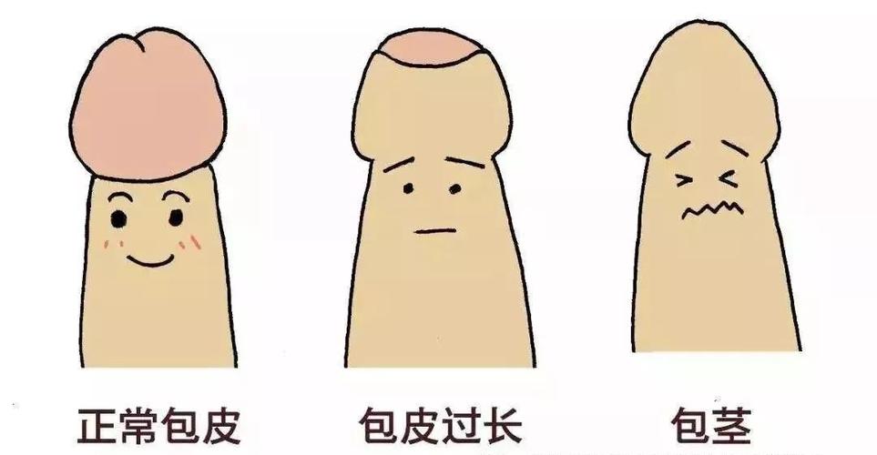 包皮过长是指自然状态下或者小鸡鸡勃起时包皮仍包着龟头不能露出,但