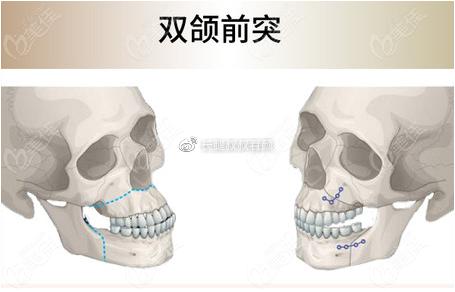 双颌前突