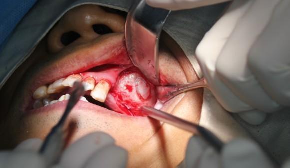 开窗,上颌窦膜完整.3.切开翻瓣,粘膜厚度大.2.术前x光片.1.