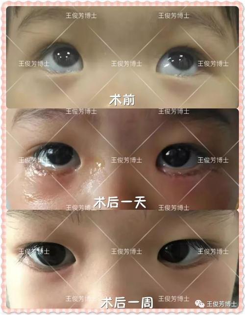 如何纠正倒睫毛