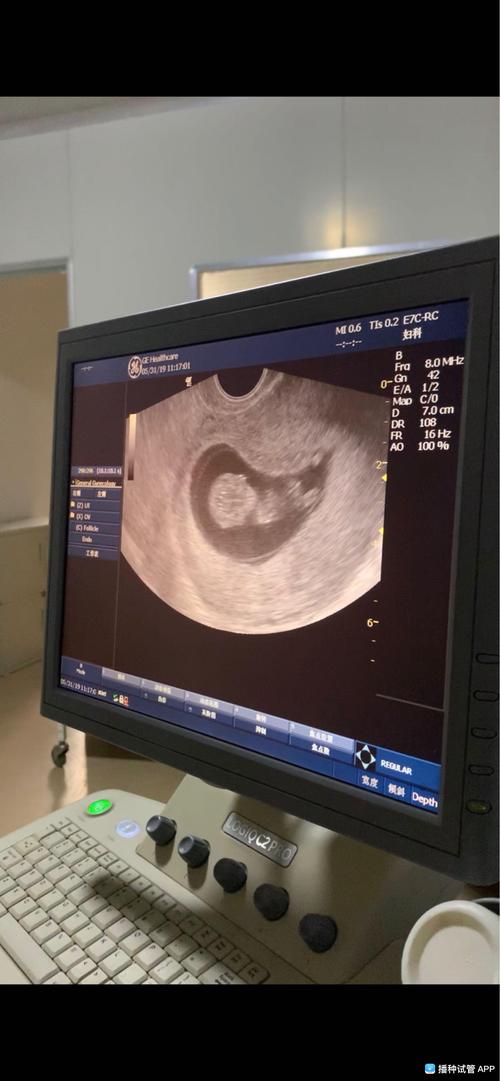 [试管婴儿]孕10周 1,宝宝在肚子里活蹦