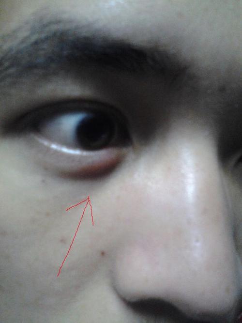 我这个是不是麦粒肿