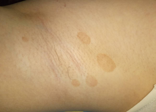 苹果绿 保健常识 汗斑属于人体的一种皮肤疾病,得了这种疾病,不仅会
