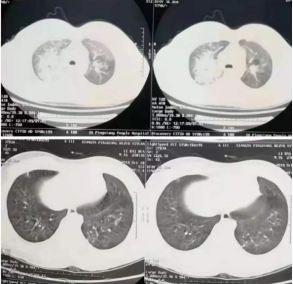 新冠肺炎患者肺部ct图