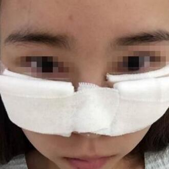 在河南开封艺美医学整形医院做完内吸去眼袋后前后判若两人
