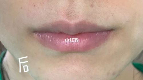 激光脱唇毛3_脱唇毛_十一去哪玩_激光脱毛_去唇毛_美妆_医美整形