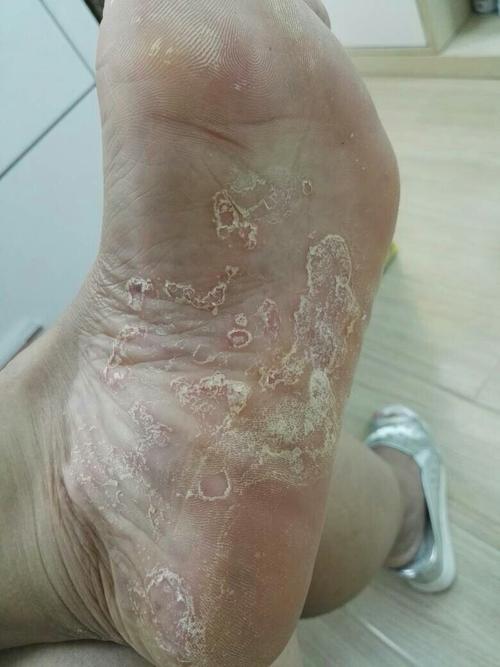 脚底板痒了多年,在皮肤医院诊断为湿疹,就是半夜痒的难受,不知道用了