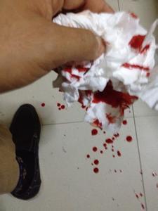 梦见自己手出血是什么预兆