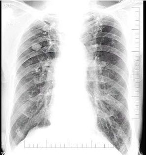 呼吸内科学医学高级气道疾病章节练习20170201
