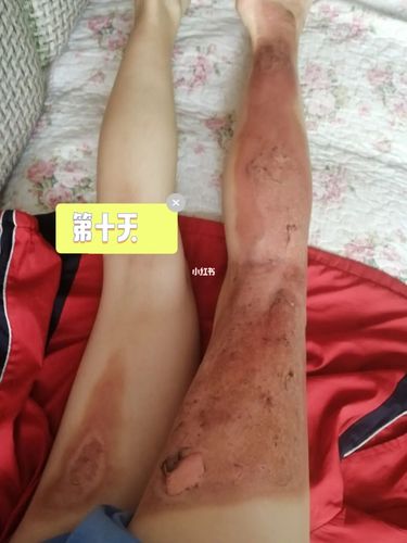 一度浅二度烧伤(我这十天来的经历和感受)_烧伤_电扇_药膏_烫伤_胃病