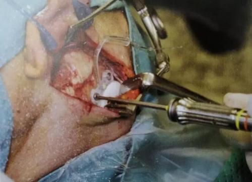 人工耳蜗那些事儿人工耳蜗手术流程详解上