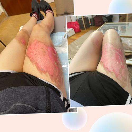 浅二度开水烫伤日记 - 第9天和第10天_烫伤_北京攻略