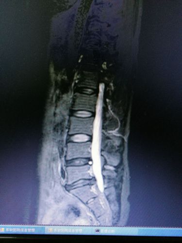 核磁共振显示腰5骶1椎间盘突出