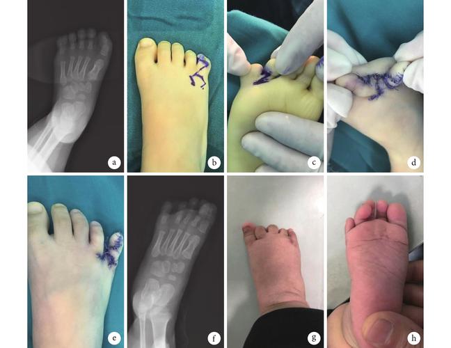 足背六边形皮瓣在第 4,5 趾并趾伴小趾多趾畸形矫形中的应用