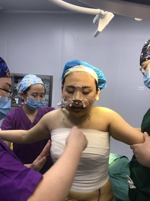 【乳房下垂矫正】私信看手术视频【南雅花苞提升术】提胸 产后/减肥