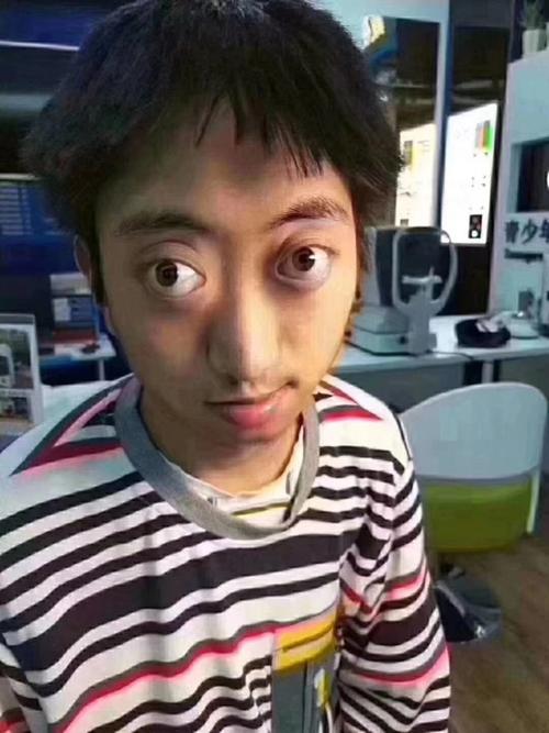 高度近视引发眼球外凸,好吓人