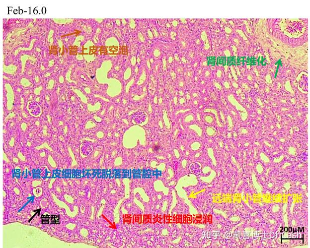 剂量组的肾脏切片中,可以看到的病理特征包括:明显的肾间质炎性细胞