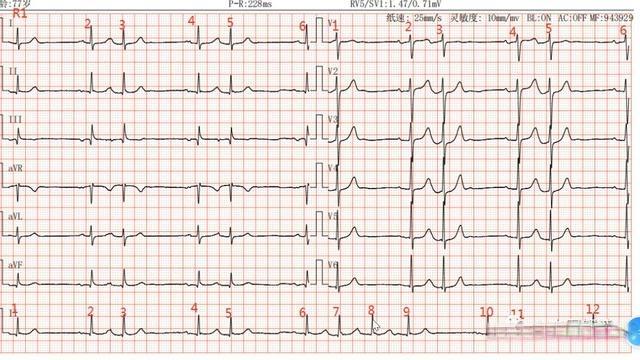 今天的心电图视频解析房早房速