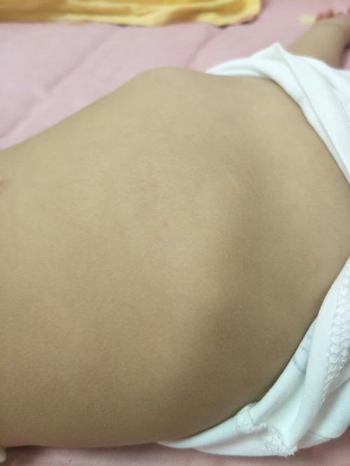 宝宝六个月开始发现肋骨外翻,现在十个月了感觉越来越