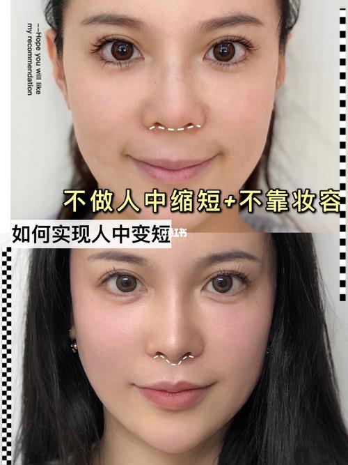 不做人中缩短 不靠妆容 如何实现人中变短_玻尿酸_唇部_妆容_唇角