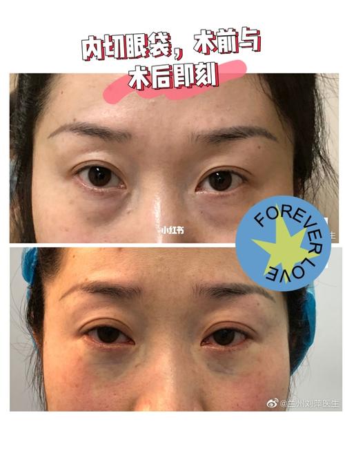 内切眼袋,术前与术后即刻对比照_眼袋_医美_医美分享