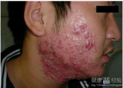 痤疮囊肿怎么治疗