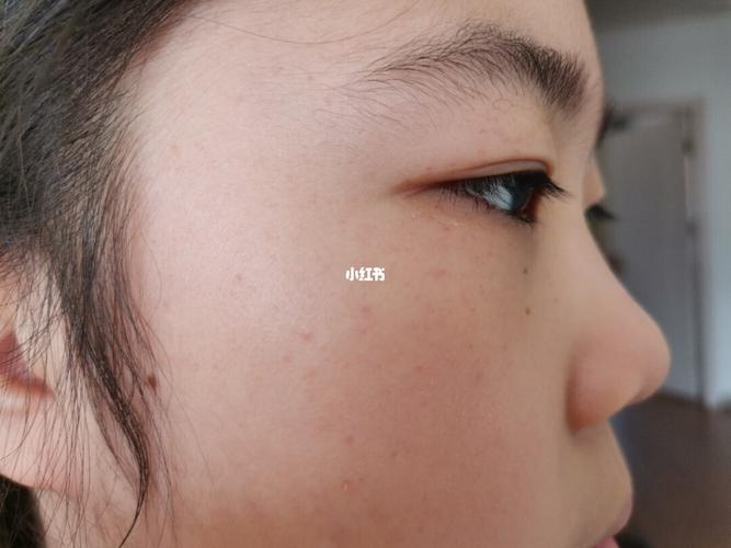 孩子眼睛周围有红点_咳嗽_母婴_育儿经验