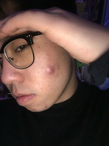 脸上长了个这种痘,一按就疼,特别大,怎么办