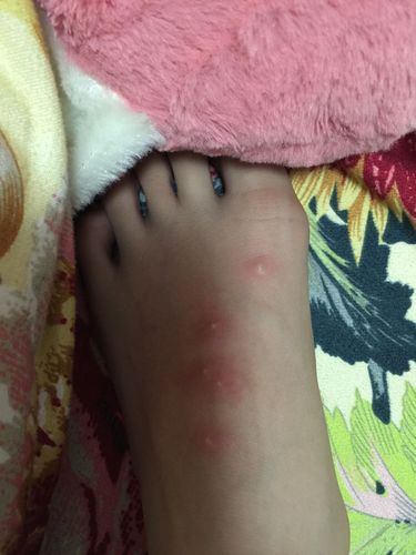 我脚上长的是什么呀?很痛,很痒,但不是被蚊子叮的.这是什么?