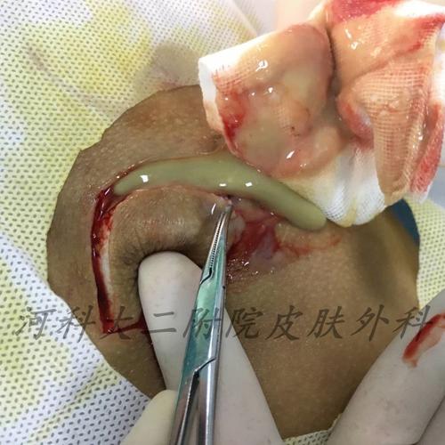 图2-2:切开,可见大量脓性分泌物,充分引流,清创(皮肤外科团队:史金龙
